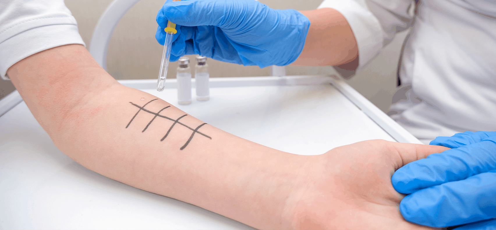 Allergy test to determine allergens causing symptoms