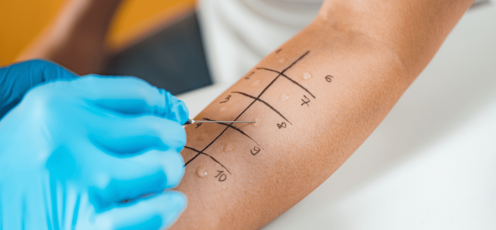 Allergy Testing Methods: Understanding the Differences between Scratch  Tests and Patch Tests